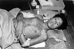 Выживший после бомбардировки Нагасаки, 1945 год